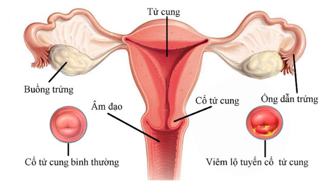 Bệnh viêm lộ tuyến cổ tử cung là gì