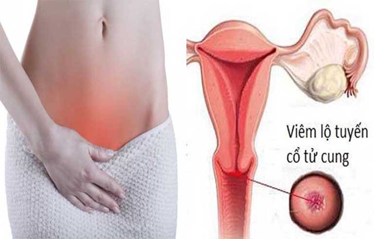 Phụ nữ bị viêm lộ tuyến cổ tử cung là như thế nào