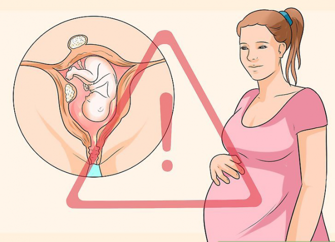 U xơ tử cung khi mang thai là gì