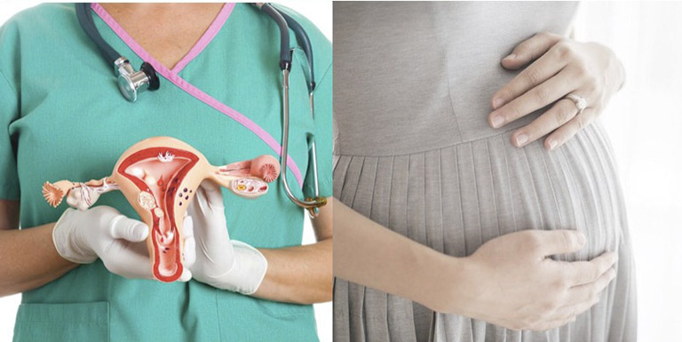 U xơ tử cung khi mang thai: Dấu hiệu và cách chữa hiệu quả