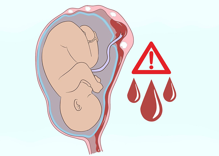 U xơ tử cung dưới niêm mạc khi mang thai