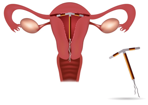 Đặt vòng tránh thai là gì?