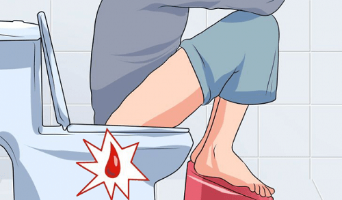 Cách chữa trĩ nội đi ngoài ra máu hiệu quả tại nhà