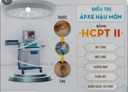 Phẫu thuật apxe hậu môn bằng HPCT II