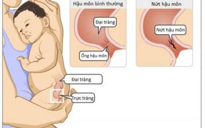 Nứt kẽ hậu môn ở trẻ sơ sinh: Nguyên nhân và cách điều trị