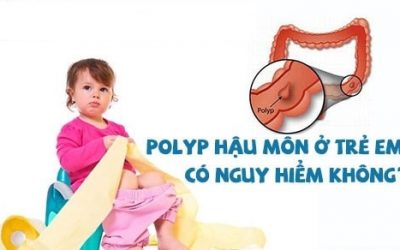 Polyp hậu môn ở trẻ em là bệnh gì? Có nguy hiểm không?