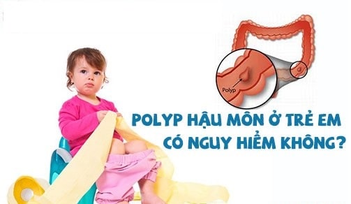 Polyp hậu môn ở trẻ em