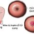 Quan sát hình ảnh viêm lộ tuyến cổ tử cung theo các giai đoạn tiến triển của bệnh