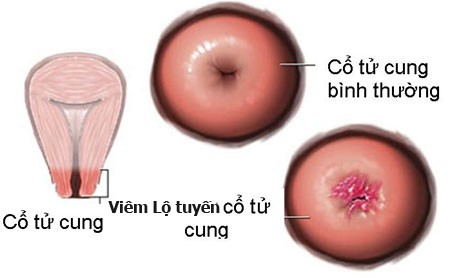 Quan sát hình ảnh viêm lộ tuyến cổ tử cung theo các giai đoạn tiến triển của bệnh