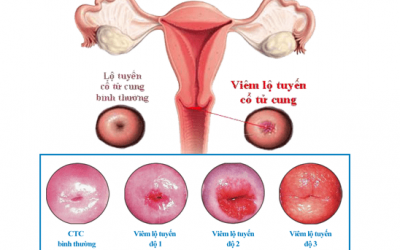 Nguyên nhân viêm lộ tuyến cổ tử cung và cách phòng ngừa hiệu quả