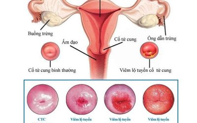 [Góc giải đáp] Triệu chứng viêm lộ tuyến cổ tử cung ở nữ giới là gì?
