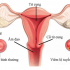 Viêm lộ tuyến cổ tử cung có nguy hiểm không? Chuyên gia giải đáp