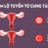 Viêm lộ tuyến tái tạo cổ tử cung là gì, cách điều trị như thế nào hiệu quả?