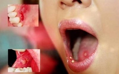 Những điều cần biết về bệnh giang mai ở miệng, cách điều trị thế nào hiệu quả?