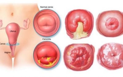 Chuyên gia giải đáp thực hư bệnh viêm lộ tuyến cổ tử cung có gây vô sinh hay không?