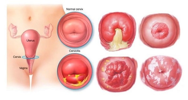 Chuyên gia giải đáp thực hư bệnh viêm lộ tuyến cổ tử cung có gây vô sinh hay không?
