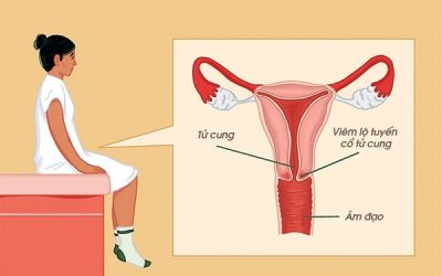 Giải đáp thắc mắc: Bệnh viêm lộ tuyến cổ tử cung có lây không?