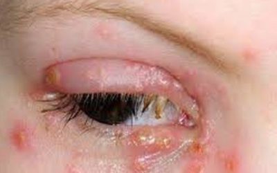 Tổng hợp những thông tin chi tiết về bệnh lậu mắt