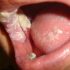 [Tổng hợp] Triệu chứng bệnh lậu ở miệng và cách điều trị
